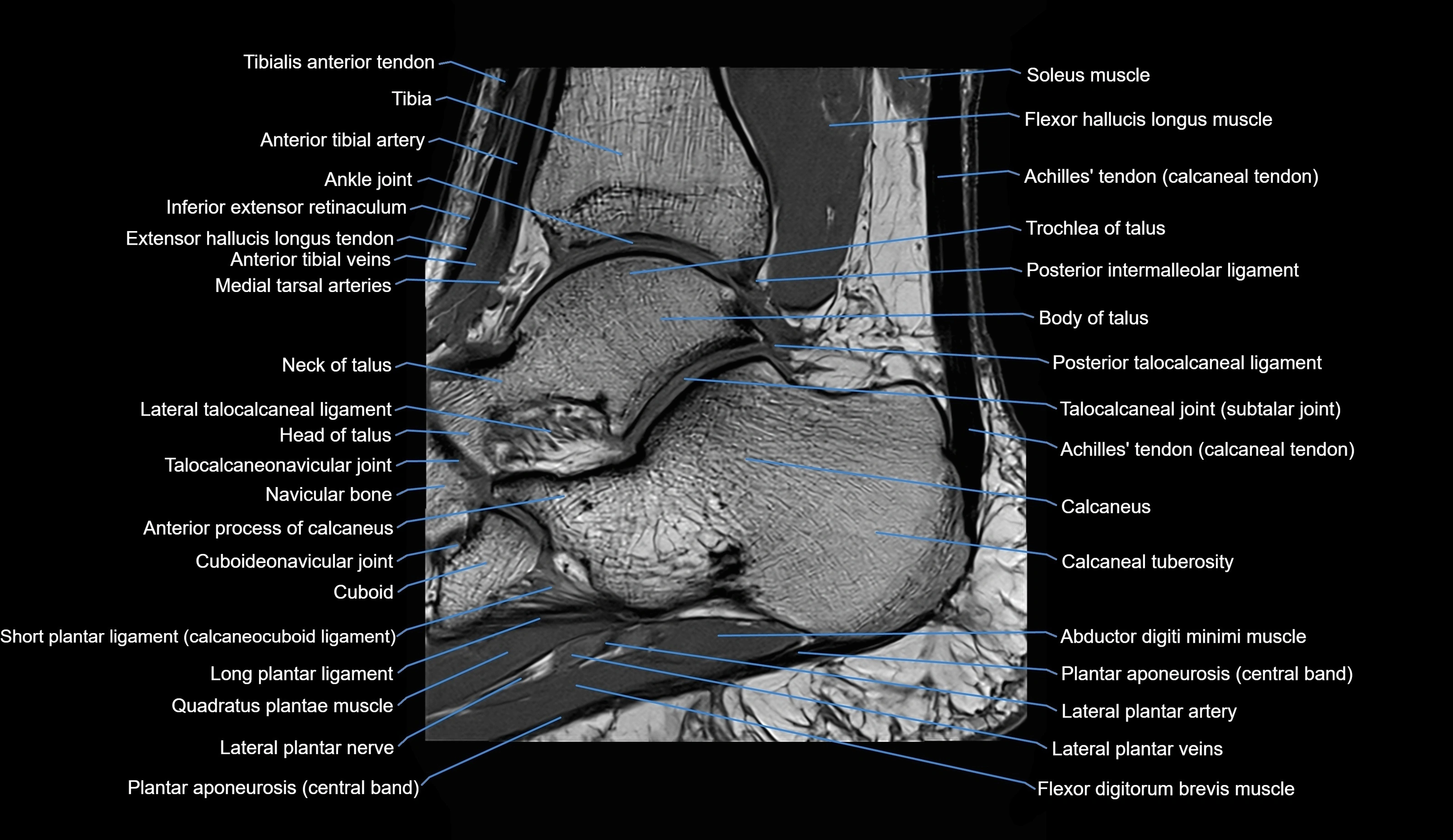 MRI Ankle sagittal cross sectional anatomy 3T  radiology  image-img-00001-00019.webp